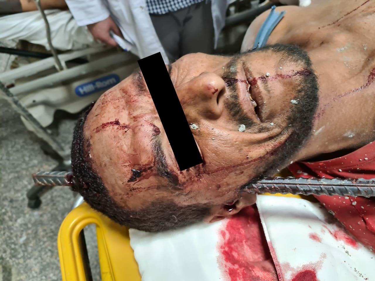 فريق طبى بجامعة أسيوط ينجح فى استخراج سيخ حديد من جمجمة شاب ثلاثينى