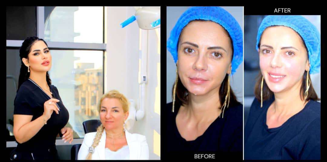 د.إسراء رسول تكشف حقائق عمليات تجميل الوجه الزائدة وفوائد الفيلر والبوتوكس